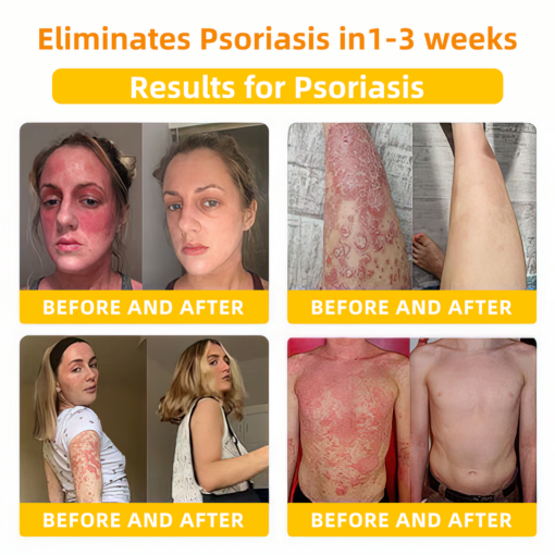 LOVILDS⢠Bee Toxin Skin Repair Cream(AAD Recommendedđ¨ââď¸)