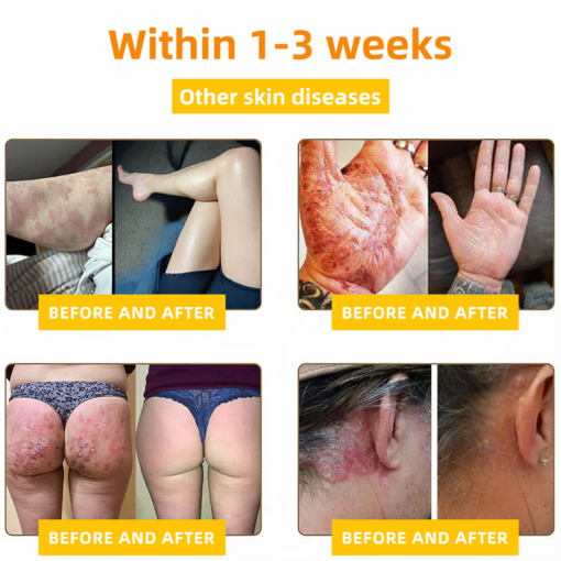 LOVILDS⢠Bee Toxin Skin Repair Cream(AAD Recommendedđ¨ââď¸)